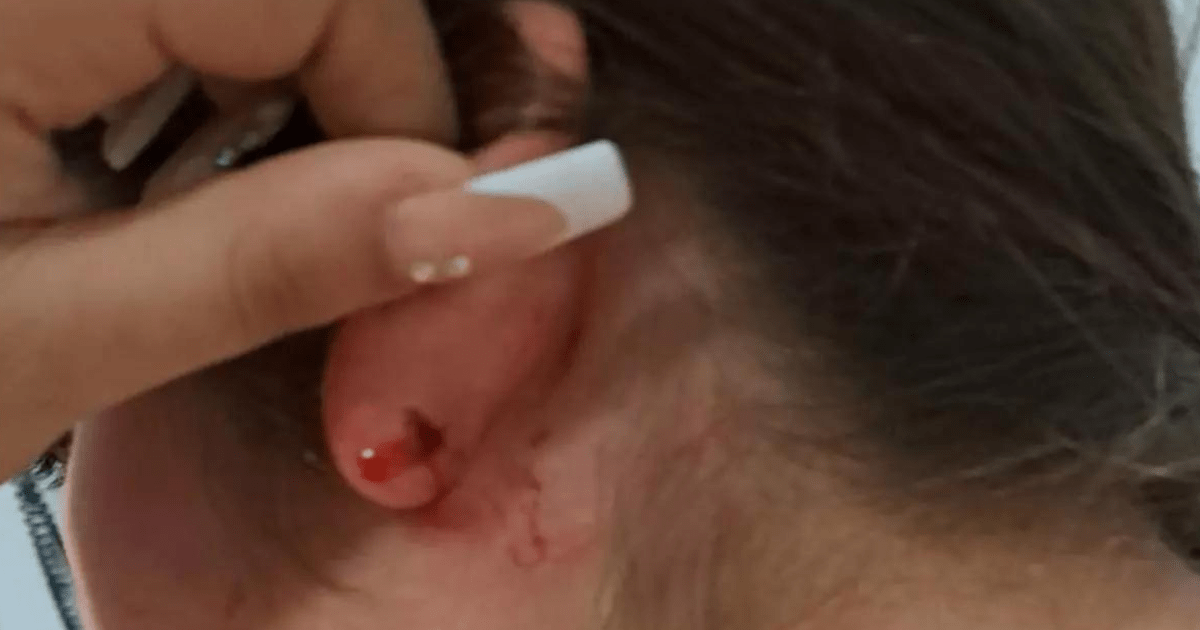 Primer plano de las heridas sufridas por una menor trans en Granada tras una agresión tránsfoba, mostrando lesiones en la oreja.
